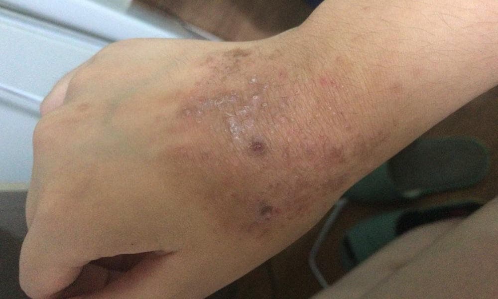 Moringa and Eczema Set 39 | Natpurity - Moringa Health Supplements & Skincare Malaysia