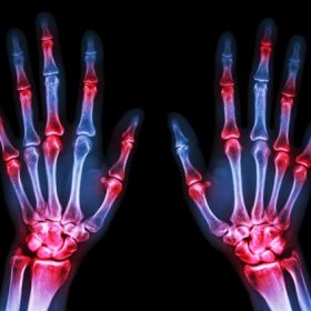 arthritis hands